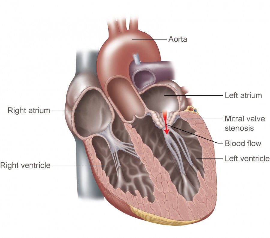 mitral-valve-stenosis-temple-health